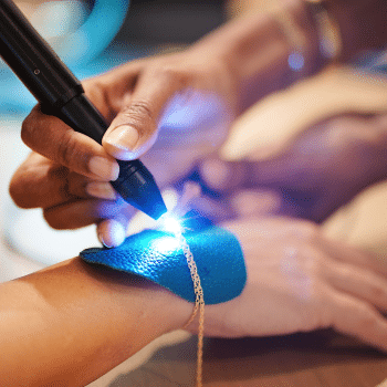 Close-up of a person undergoing laser hair removal on the forearm.